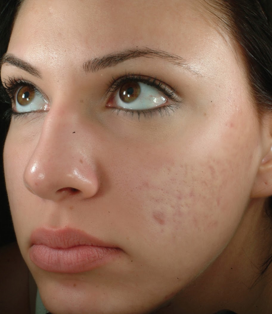 mild acne scars